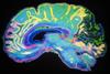 پژوهشگران به درک عمیق‌تری در مورد پیچیدگی مغز انسان رسیدند