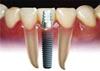 95 درصد موفقیت باز سازی استخوان دندان با ایمپلنت