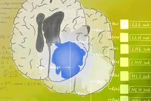  درمان تومور مغزی با کمک هوش مصنوعی