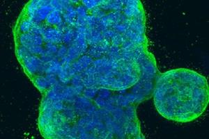  دانشمندان به مکانیزم مخفی شدن سلول‌های سرطان سینه پی بردند