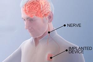 توسعه یک درمان نوین برای بهبود حرکت در بیماران سکته مغزی