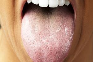 تشخیص سرطان پانکراس با بررسی باکتری زبان!