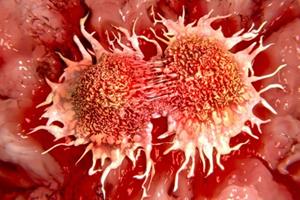 روش جدیدی برای پیشگیری از متاستاز تومورهای سرطانی