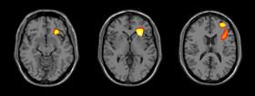 نتایج یک تحقیق: مغز دو قطبی‌ها متفاوت از سایرین رشد می‌کند 