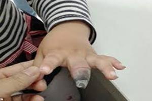انگشت سیاه شده نتیجه خود درمانی این مادر بزرگ 