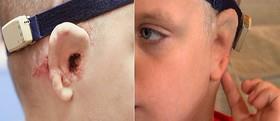 پیوند گوش‌های بازسازی شده به کودک هشت ساله