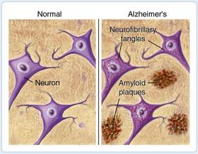 مشاهده نشانه‌های آلزایمر، 50 سال قبل از بروز بیماری 