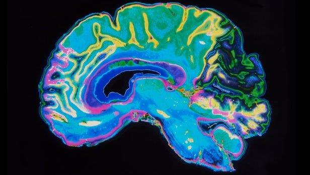  تشخیص تمایل به خودکشی با تصویربرداری مغز و یادگیری ماشینی