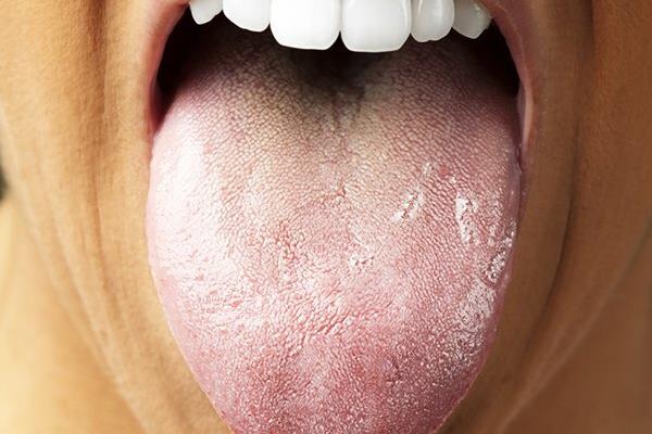تشخیص سرطان پانکراس با بررسی باکتری زبان!