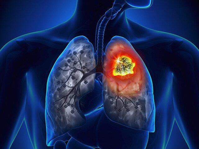  کاهش مرگ‌ومیر ناشی از سرطان ریه با مدل‌های جدید پیش‌بینی