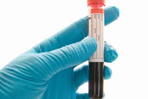 ابداع آزمایش خون برای تشخیص پنج سرطان مرگبار 
