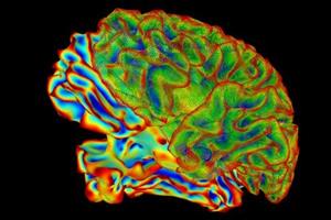  کشف غیرمنتظره علت پیشرفت آلزایمر در مغز