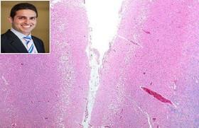 ابزار دانشمند ایرانی و همکارانش برای حذف لخته خون در سکته مغزی تایید شد 