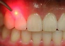 نانوحاملی برای محافظت از دندان در برابر پلاکت‌ باکتری‌ها 
