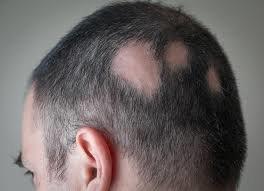 رشد دوباره مو روی پوست آسیب‌دیده ممکن می‌شود