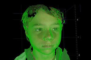 تشخیص بیماری‌های نادر کودکان با اسکن ۳بعدی چهره