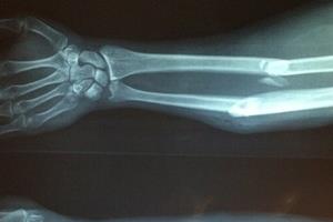 توسعه یک روش نوین برای ترمیم شکستگی استخوان