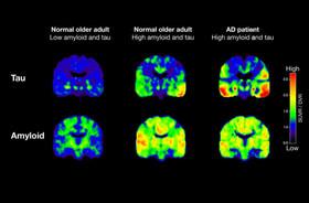 نمایش ظهور آلزایمر در مغز برای نخستین بار
