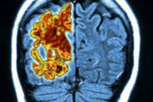 لمس غیرتهاجمی مغز برای تشخیص زودهنگام آلزایمر 