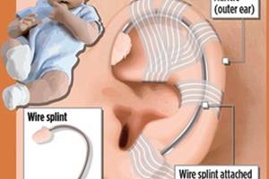 درمان بدشکلی گوش نوزادان با آتل سیمی 