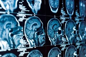 آسیب مغزی-عروقی بیماران کرونایی چند ماه پس از بهبود بیماری باقی می‌ماند