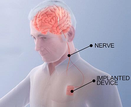 توسعه یک درمان نوین برای بهبود حرکت در بیماران سکته مغزی