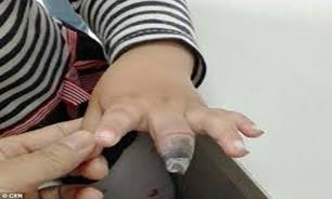 انگشت سیاه شده نتیجه خود درمانی این مادر بزرگ 
