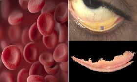 تشخیص کم خونی با فناوری خاص