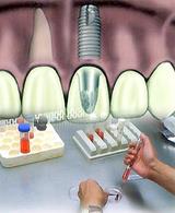 بهبود موادپرکننده دندانپزشکی با نانوذرات الماس و آنتی‌بیوتیک 