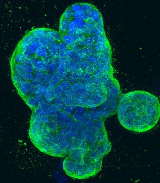  دانشمندان به مکانیزم مخفی شدن سلول‌های سرطان سینه پی بردند