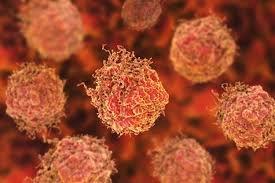  آزمایشی برای تشخیص سریع و کم‌هزینه متاستاز سرطان پروستات