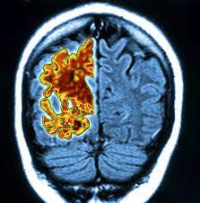 لمس غیرتهاجمی مغز برای تشخیص زودهنگام آلزایمر 