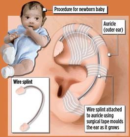 درمان بدشکلی گوش نوزادان با آتل سیمی 