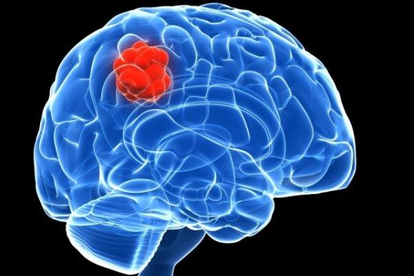 تومورهای مغزی ۵سال قبل از ظهور پیش بینی می‌شوند