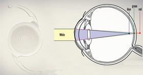 بازیابی بینایی در افراد مسن با لنز جدید 