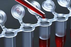پیش‌بینی خطر متاستاز کبدی با اندازه گیری پروتئینی در خون 